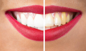Before and after Teeth Whitening